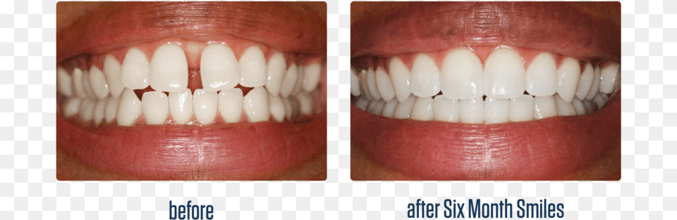 Gallery 11 Before And After Six Month Smiles, Body Part, Mouth, Person, Teeth Free Transparent Png