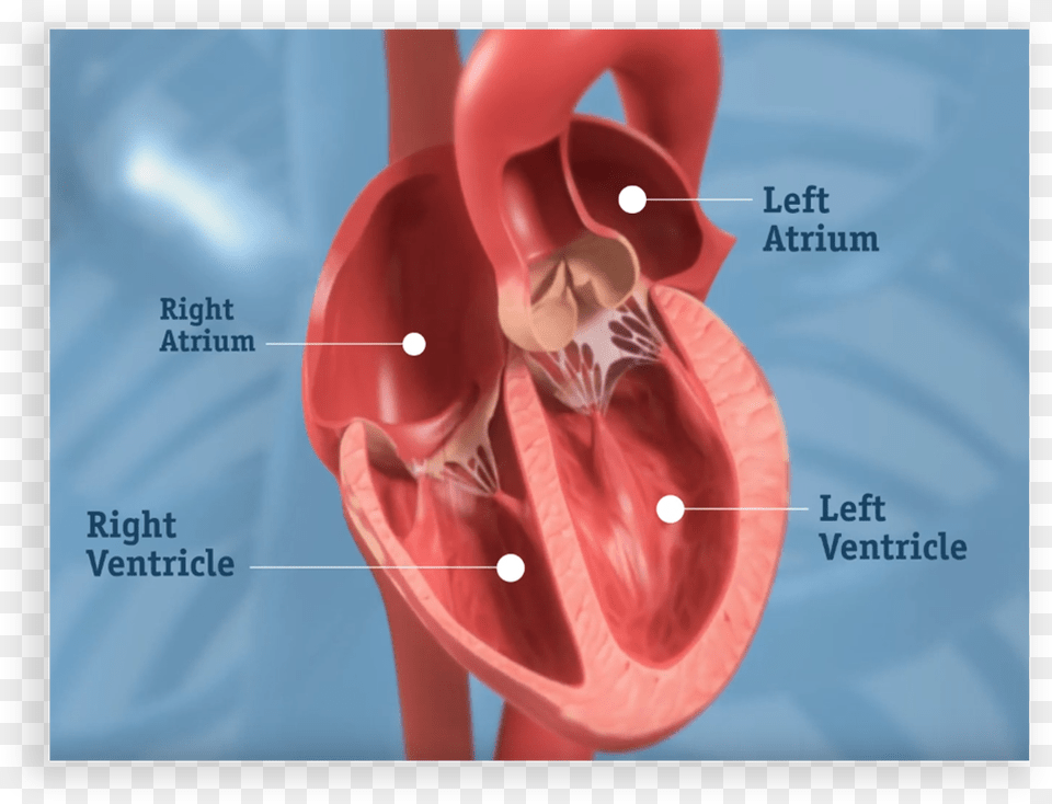 Get More Clarity About Your Dvt Treatment Options Severe Aortic Stenosis, Body Part, Stomach, Heart Png