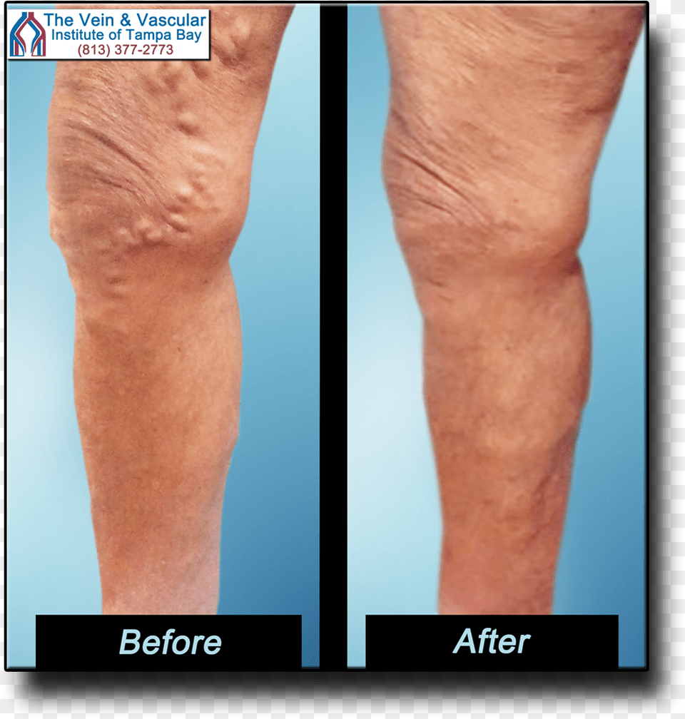 Get Rid Varicose Veins Naturally Varicose Veins Surgery, Adult, Male, Man, Person Free Png Download