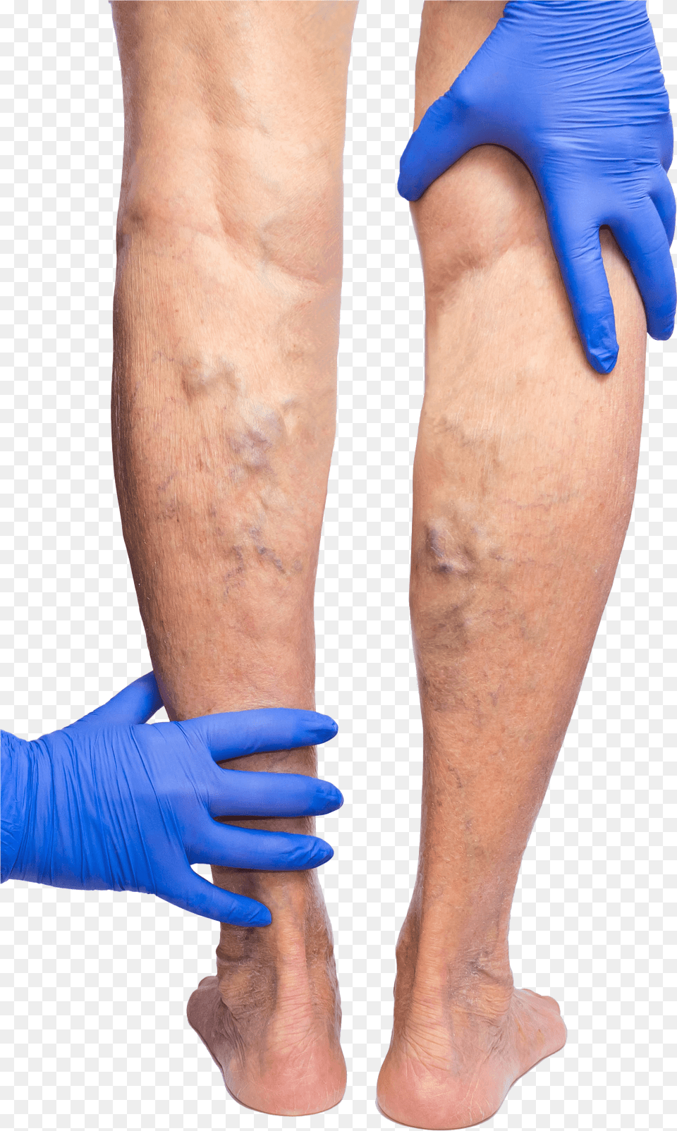 Gloved Hands Feeling The Backs Of Legs That Are Covered Phlebitis Varicose Veins, Clothing, Glove, Person, Skin Png Image