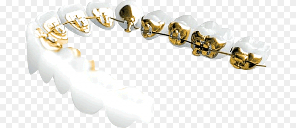 Gold Teeth Incognito Braces, Body Part, Mouth, Person, Accessories Free Png