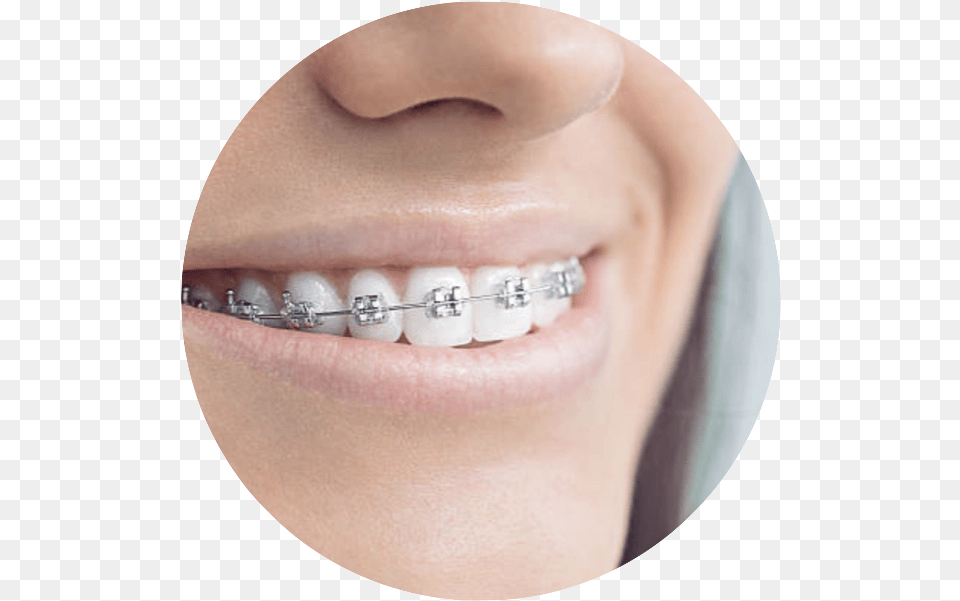 Goldstar Dental White Bands On Braces, Body Part, Teeth, Person, Mouth Free Transparent Png