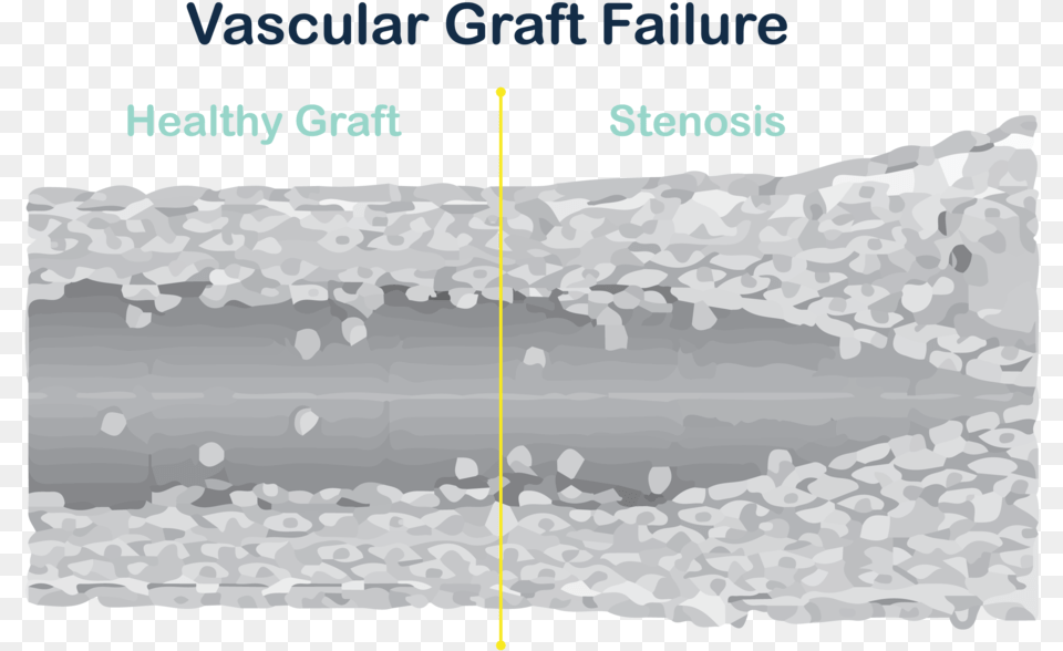 Graft Failure Diagram V2 01 Architecture, Nature, Outdoors, Sea, Sea Waves Free Png