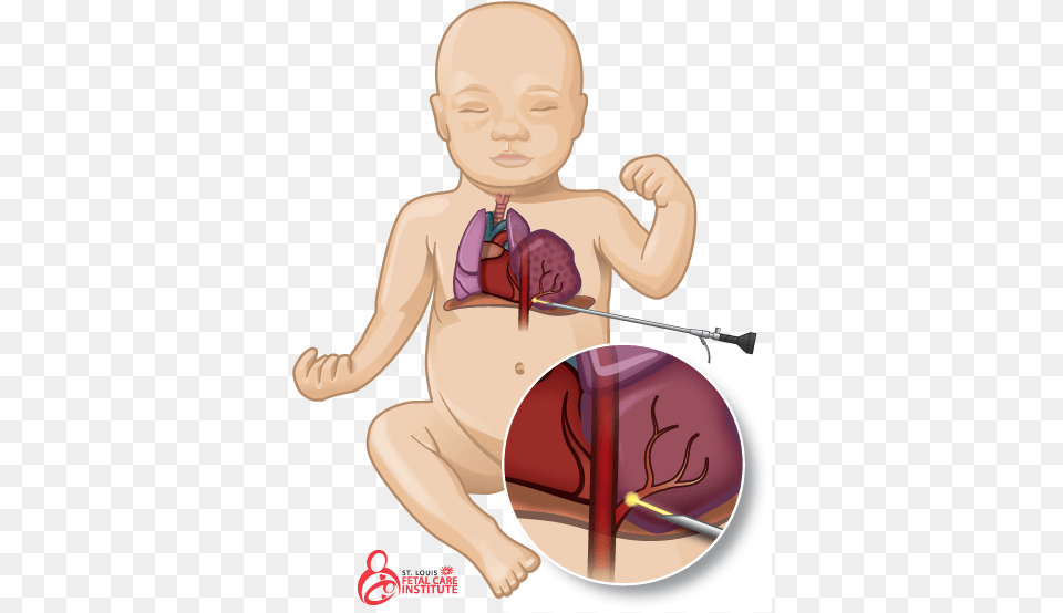 Graphic Of Baby With Bronchopulmonary Sequestration Bronchopulmonary Sequestration, Person, Face, Head, Cupid Png Image