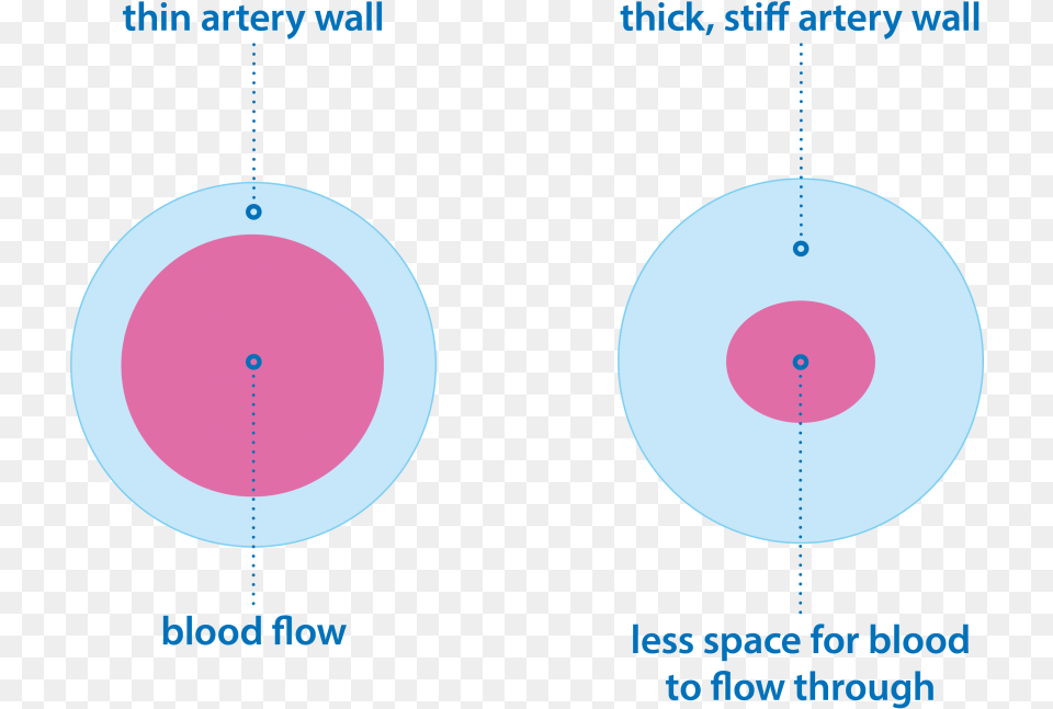 Group 1 Pulmonary Hypertension Image Showing Thick, Astronomy, Moon, Nature, Night Free Transparent Png