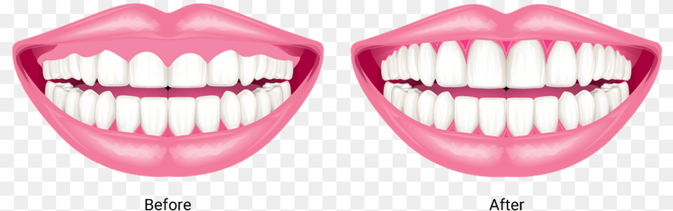 Gum Drawing Front Tooth Gums, Body Part, Mouth, Person, Teeth Free Png Download
