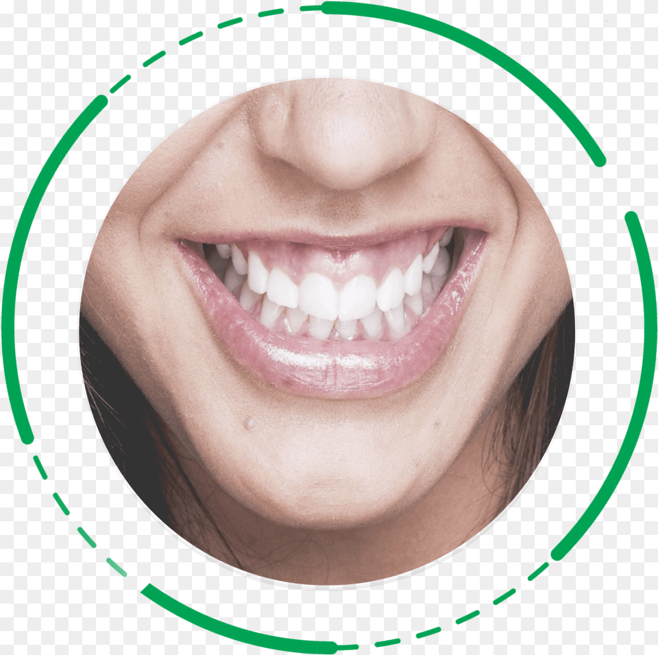 Gummy Smile Gummy Smile, Body Part, Teeth, Person, Mouth Png