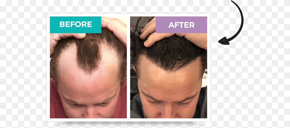 Hair Loss In Men And Women Could Stress Be The Cause Enm Long Does Hair Transplant Last, Head, Person, Face, Man Free Transparent Png
