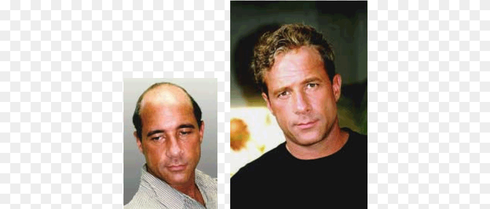 Hair Replacement Systems Before And After Hair Transplantation, Adult, Portrait, Photography, Person Png