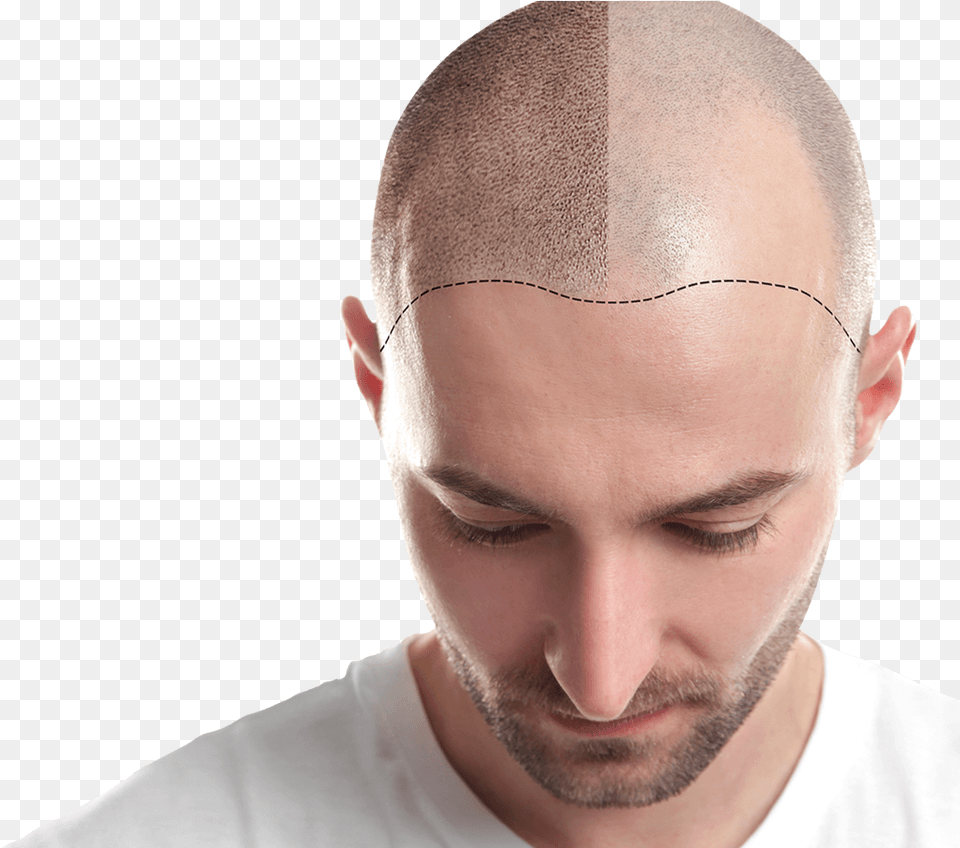 Hair Transplant In Ahmedabad Transplant Add Fue Hair, Adult, Head, Male, Man Free Png Download