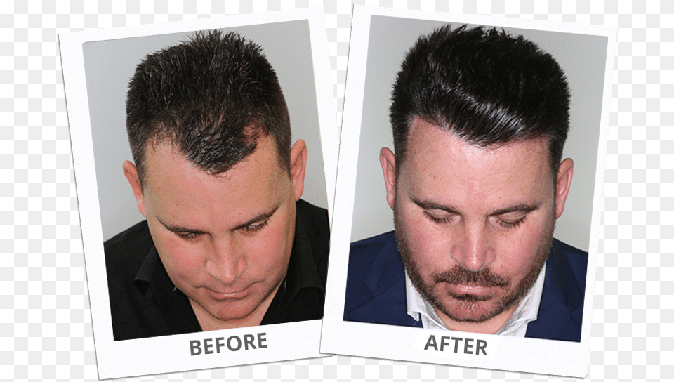 Hair Transplant Los Angeles, Head, Person, Beard, Face Free Png Download