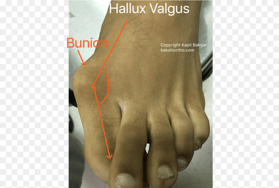 Hallux Valgus With Bunion And Overlapping Toes Poster, Ankle, Body Part, Person, Adult Free Png