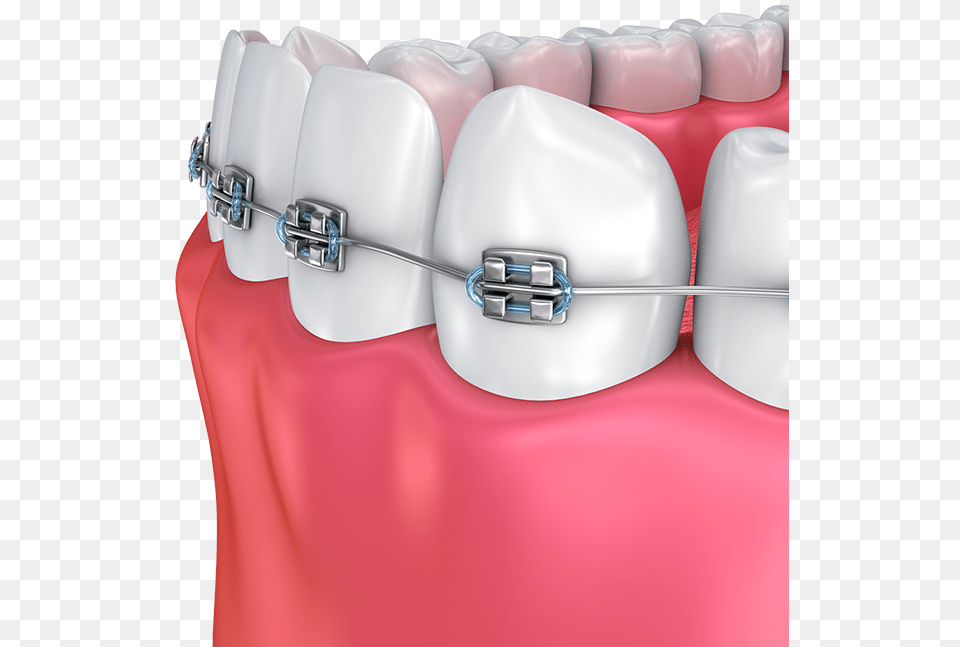 Haltom Orthodontics Dental Braces, Body Part, Mouth, Person, Teeth Free Transparent Png