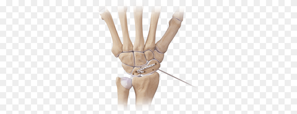 Hand And Wrist Scapholunate Repair Swivelock 0 Large Arthrex Internal Brace Scapholunate, Person Free Transparent Png