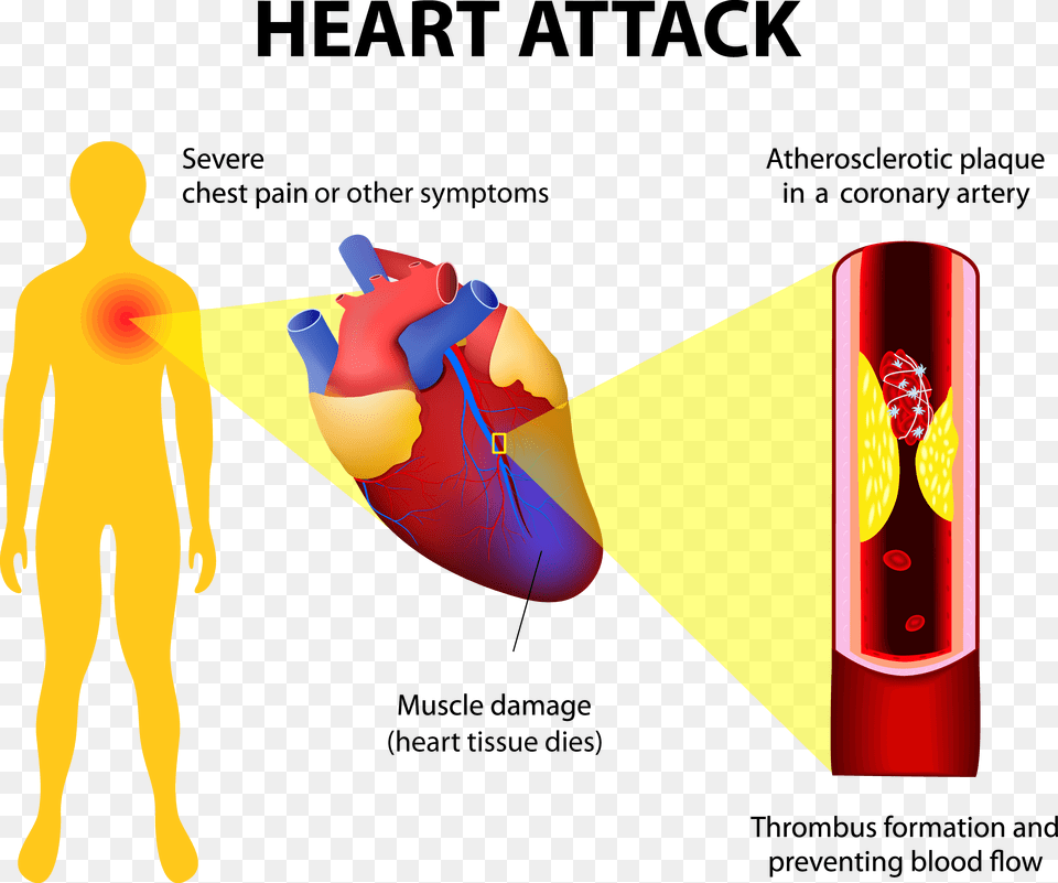 Heart Attack2 Adobestock Heart Chest Pain, Dynamite, Weapon Free Png