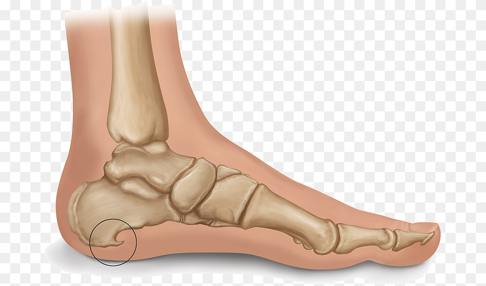 Heel Spur Illustration, Ankle, Body Part, Person, Adult Free Transparent Png