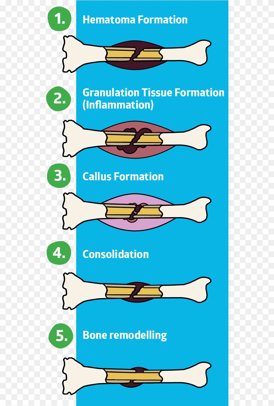 Hematoma Formation Fracture Healing Stages, Oars, Weapon, Arrow, Smoke Pipe Free Png Download
