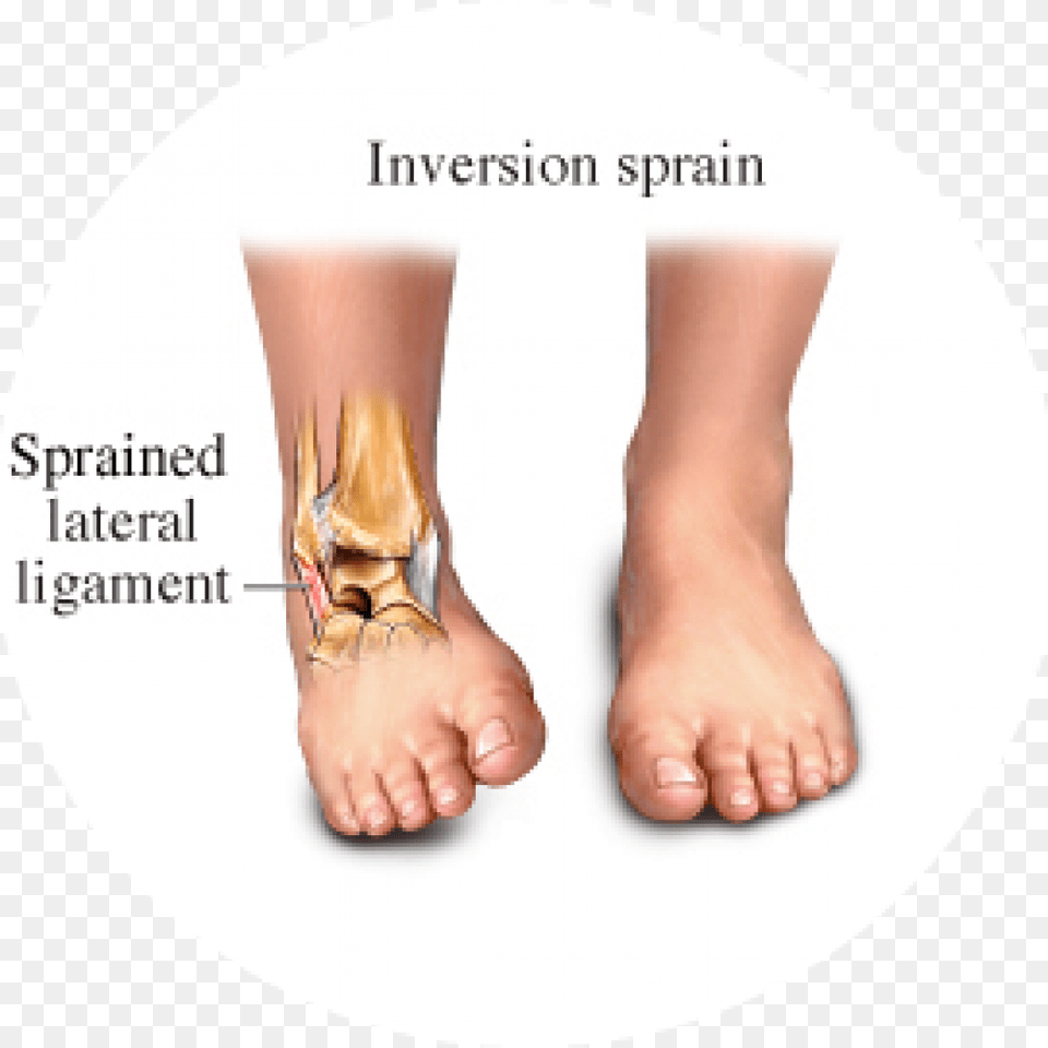 Hhg Inversion Vs Eversion Ankle Sprain, Body Part, Person, Baby Free Transparent Png
