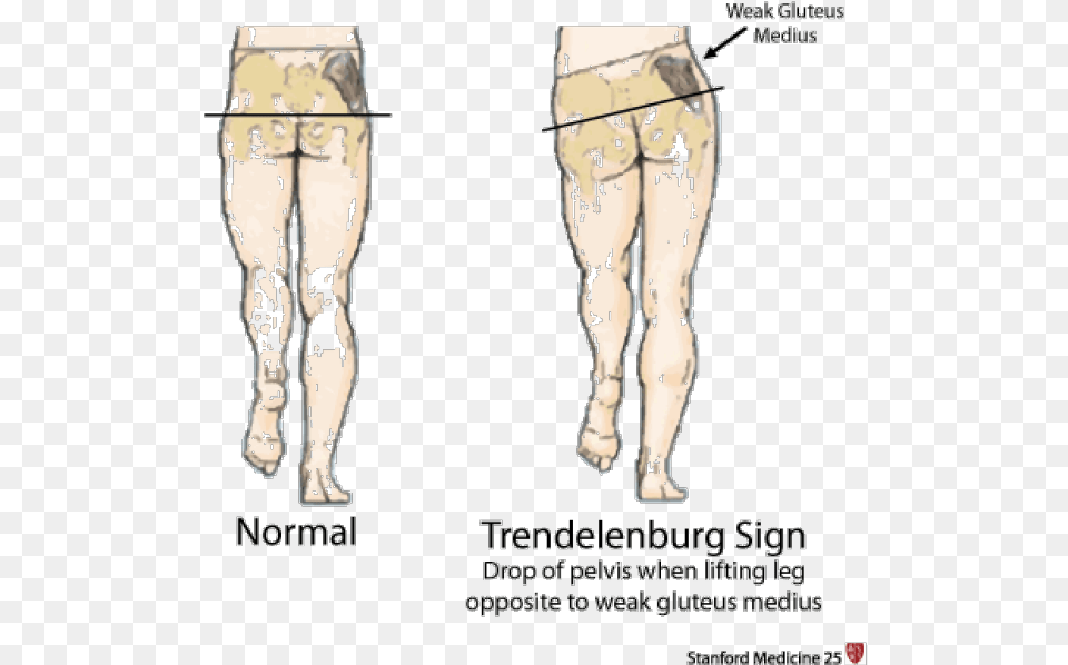 Hip Girdle Muscles Are Responsible For Keeping The Trendelenburg Sign, Plot, Chart, Adult, Person Free Png Download