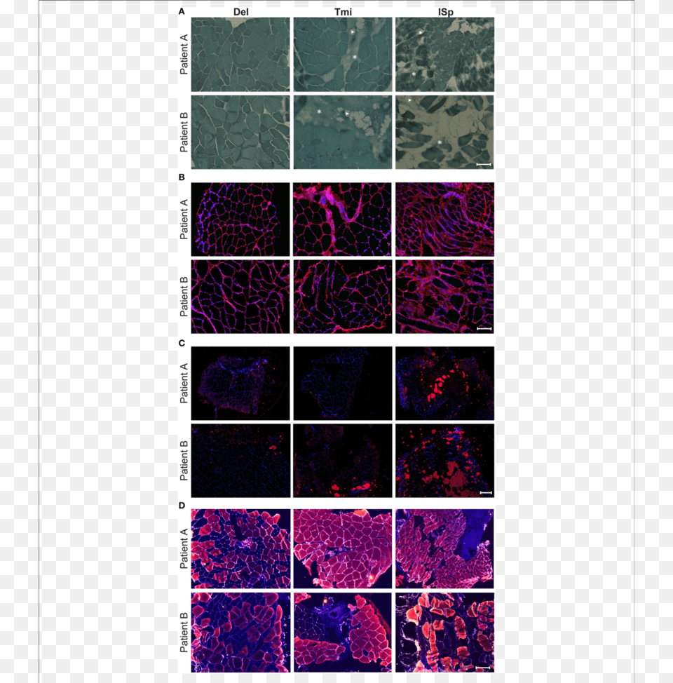 Histological Markers Of Muscle Degeneration In Torn Muscle, Purple, Art, Collage, Mineral Png