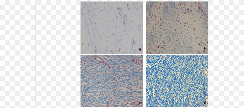 Histological Of Collagen Tissue Hyperplasia Tile, Paper, Art, Collage, White Board Png Image