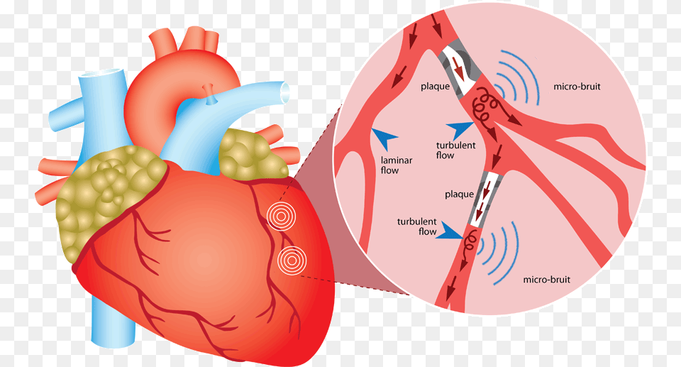 Home Ausculsciences Coronary Artery Disease Gif, Heart, Face, Head, Person Png Image