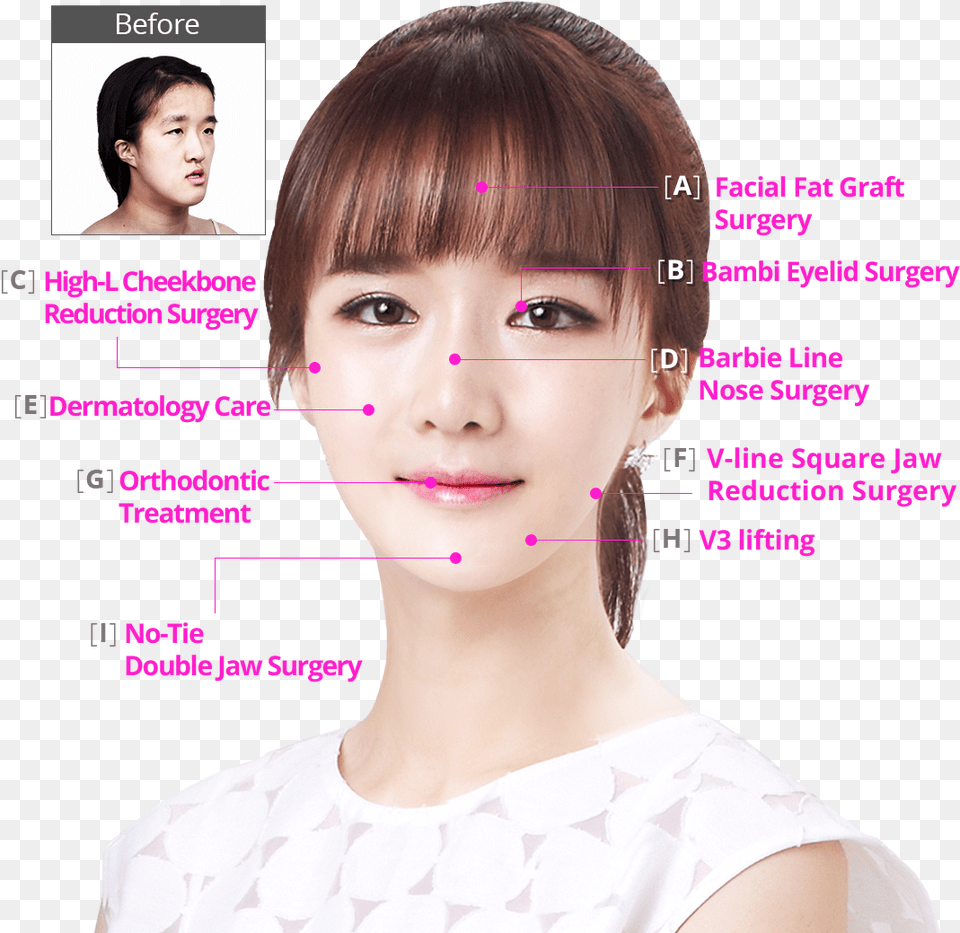 Hospital Perfect Makeover Plan Bambi Eyelid Surgery, Adult, Person, Neck, Head Png Image