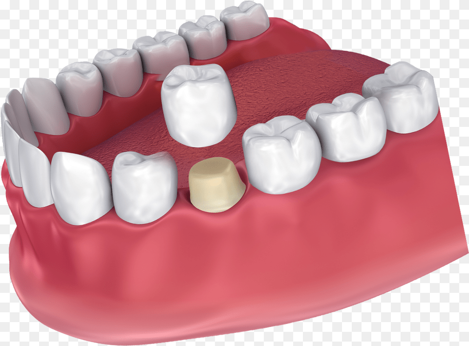 How A Dental Crown Fits Crown Dental, Birthday Cake, Person, Mouth, Food Png Image