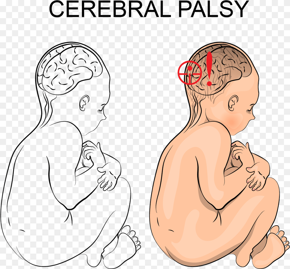 How Can I Tell If My Child Has Cerebral Palsy Cerebral Palsy Illustration, Baby, Person, Face, Head Png Image
