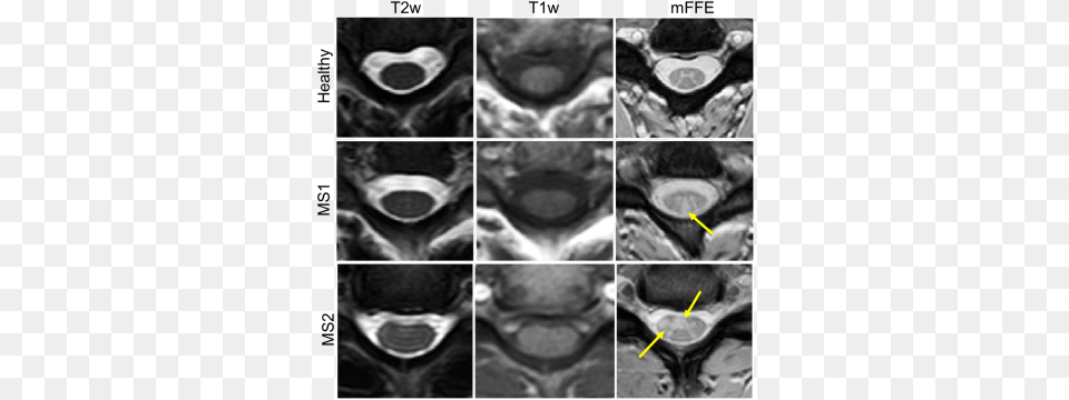 How To Optimise Spinal Cord Mr Acquisitions Computed Tomography, Ct Scan, Animal, Baby, Cat Png Image