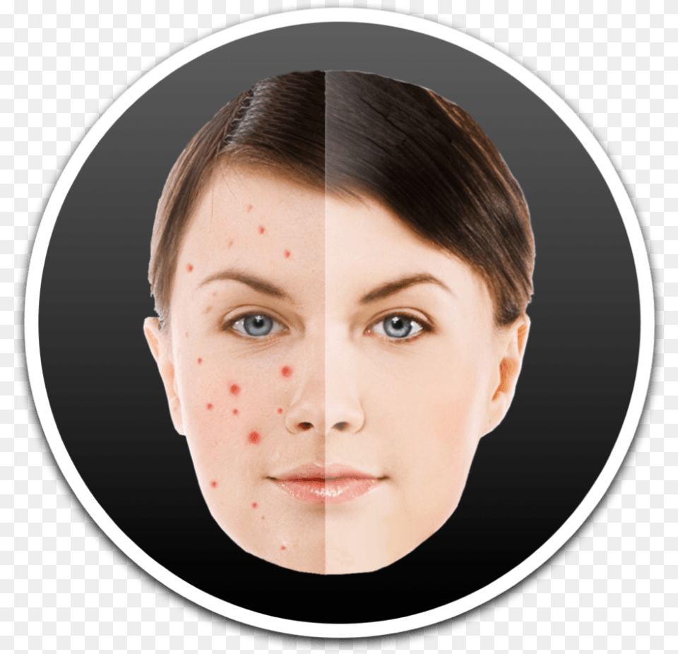 How To Remove Pimples And Blemish From Photos On Mac Acne, Adult, Face, Female, Head Png