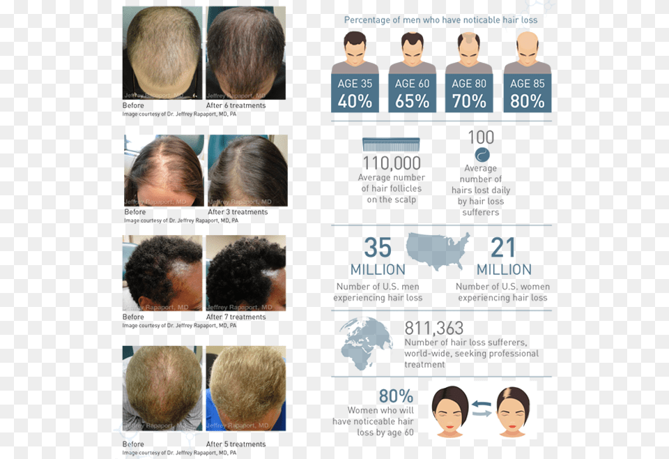 However There Is Evidence That Regular Treatments Prp Hair Restoration Rapaport, Art, Collage, Adult, Person Free Png Download