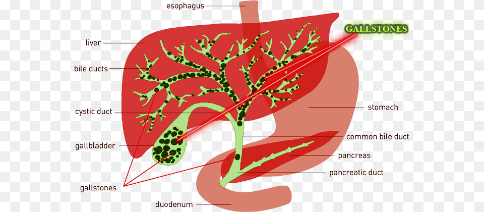 Http Tiptophomeremedies Comwp Gallstones Liver Gallbladder Cleanse, Chart, Plot, Dynamite, Weapon Png