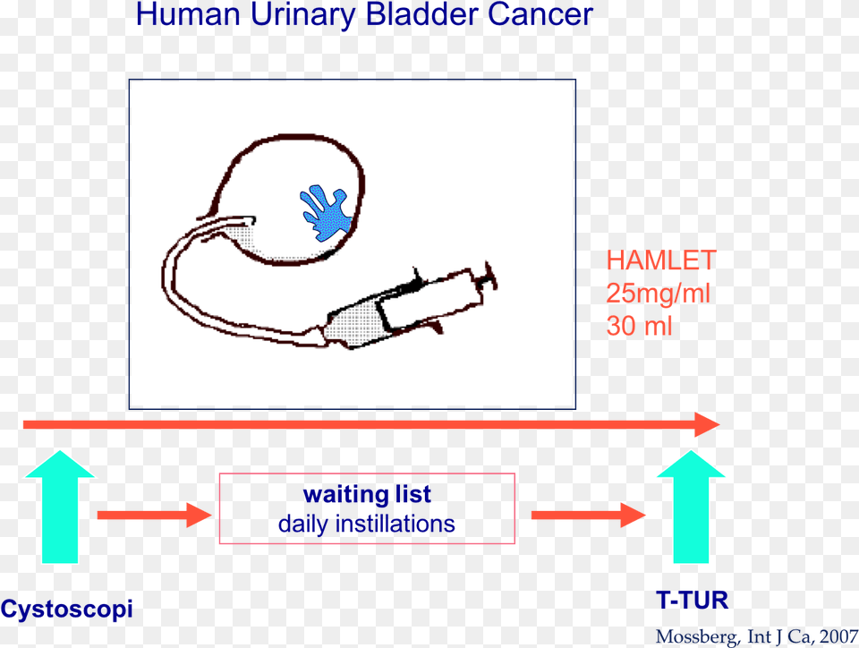 Human Urinary Bladder Cancer Treatment With Hamlet Human Png Image