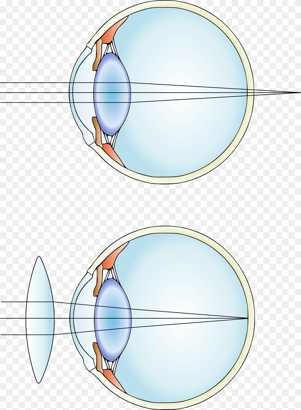 Hypermetropia And Correction Convex Lens Uses, Sphere, Cutlery Free Transparent Png