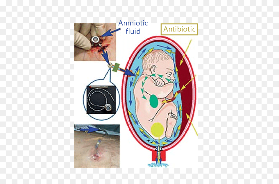 Hypoosmotic Saline Solution With Antibiotic Used To Amnioinfusion, Architecture, Hospital, Building, Baby Png Image