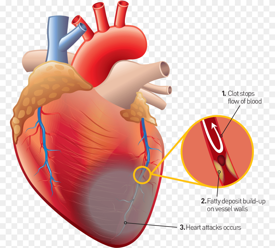 If The Oxygen Supply Is Reduced In The Blocked Artery Imagens De Humano, Heart Free Png