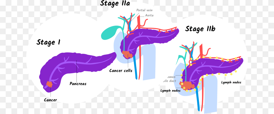 Illustration Of Stage I And Stage Iia And Iib Pancreatic Stage 1 Stage 2 Pancreatic Cancer, Ct Scan, Water Sports, Water, Leisure Activities Png