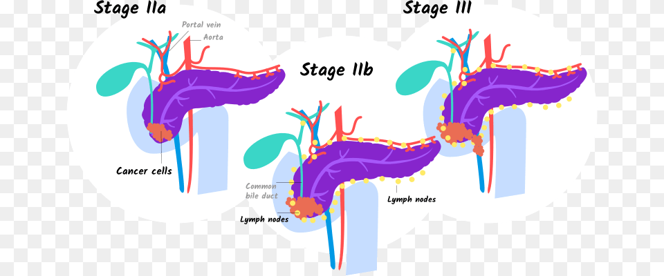 Illustration Of Stage Iia Iib And Stage Iii Pancreatic 4 Pancreatic Cancer Stages That Help You, Ct Scan Free Transparent Png