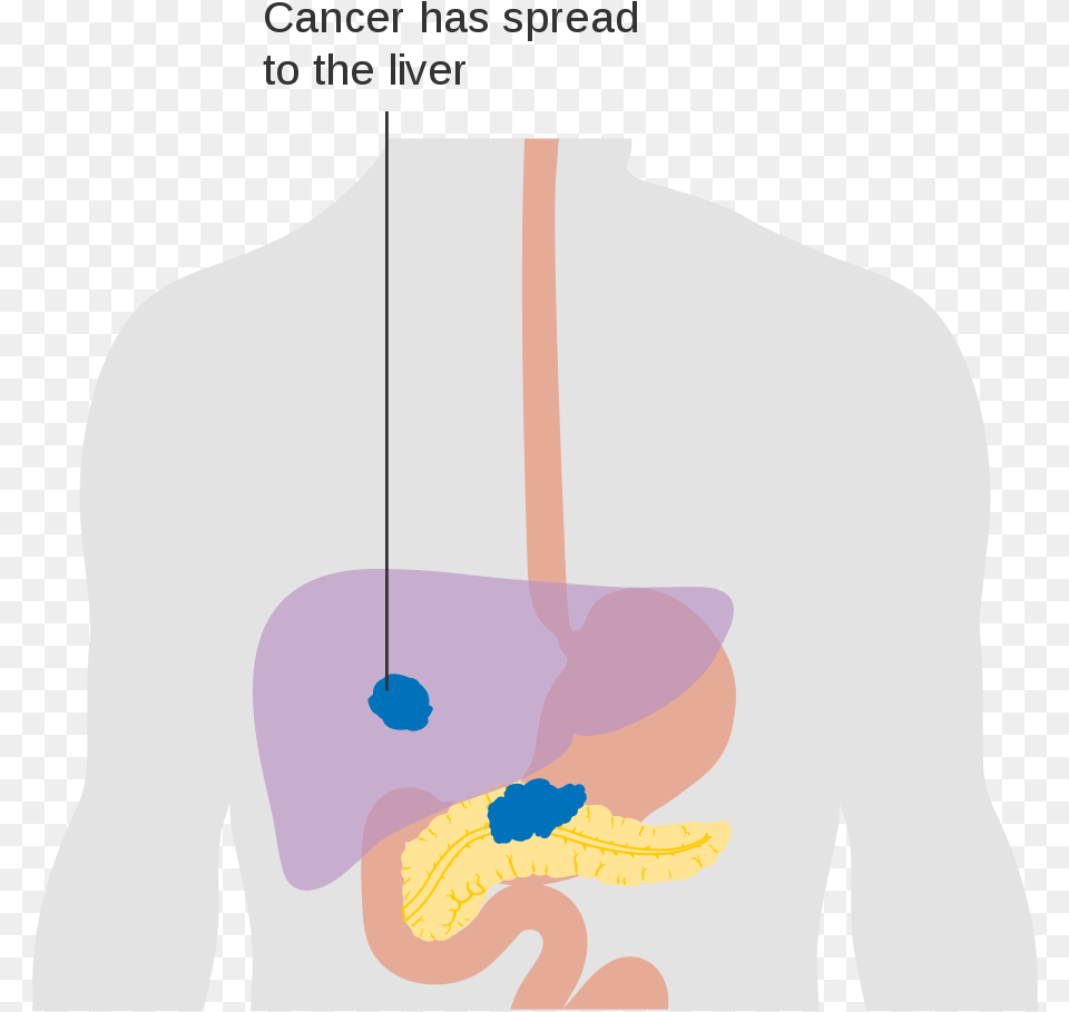Illustration Pancreatic Cancer, Adult, Male, Man, Person Png Image