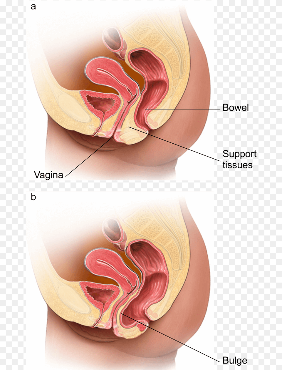 Illustration Showing A Normal Vagina And One With A Posterior Prolapse, Body Part, Stomach, Adult, Female Png