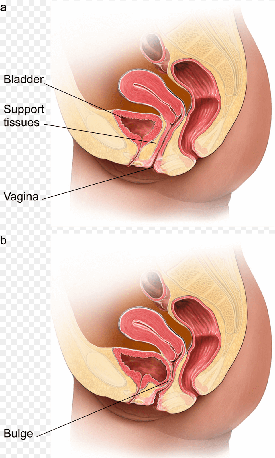 Illustration Showing A Normal Vagina Compared To One Prolapse Back Vaginal Wall, Body Part, Stomach, Face, Head Png