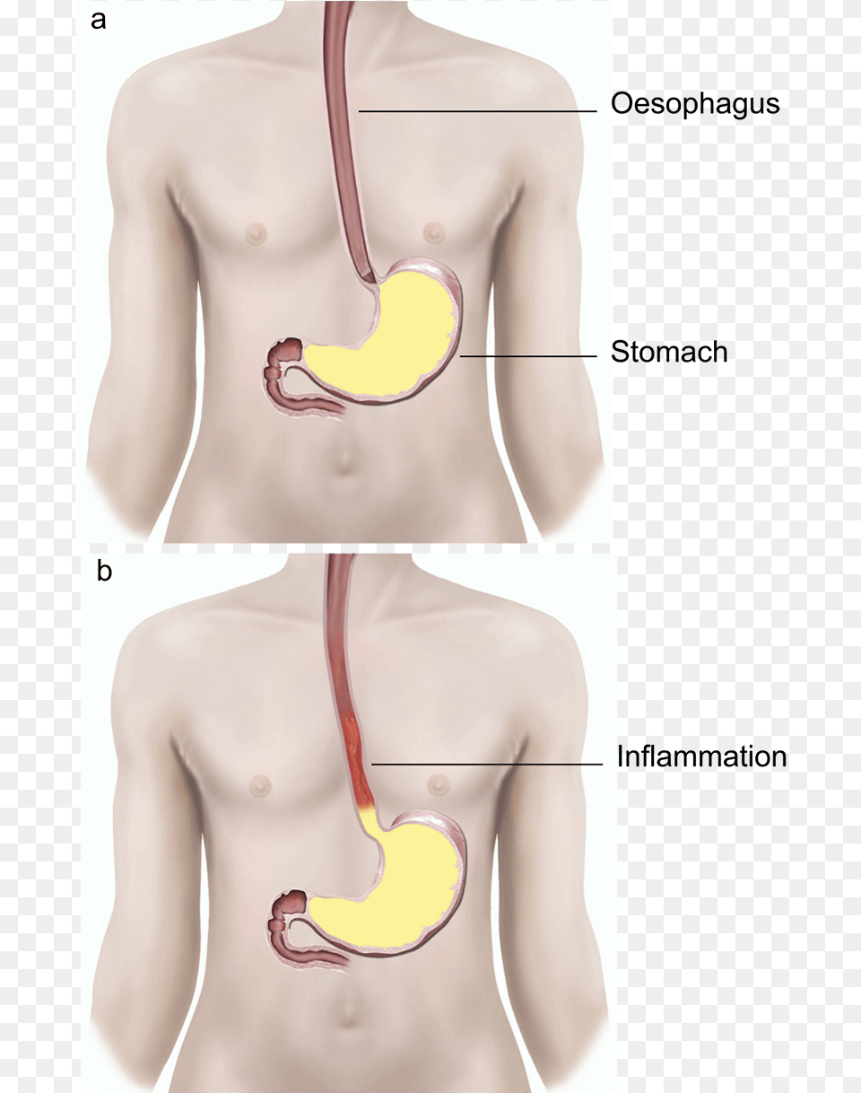 Illustration Showing A Normal Valve And A Faulty Valve Gerd Surgery Scar, Body Part, Stomach, Adult, Male Free Transparent Png