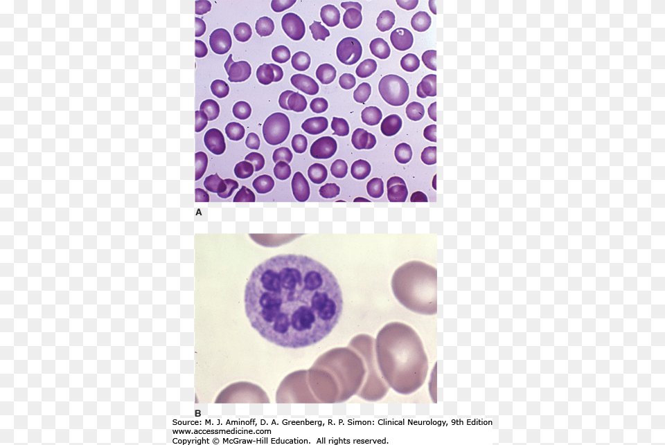 Image Not Available Pernicious Anemia Cytology Free Transparent Png