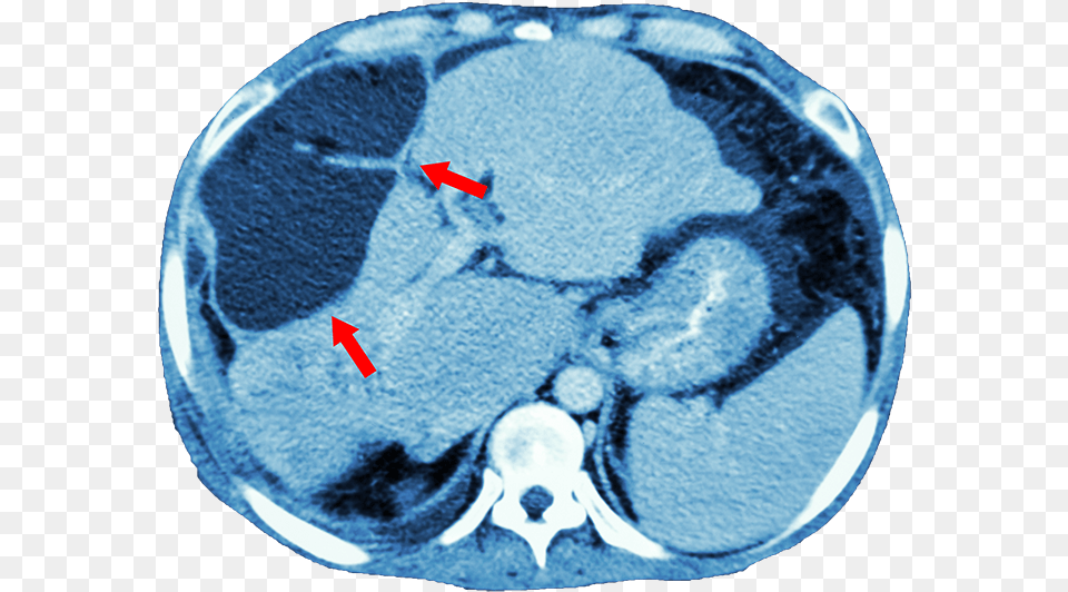 Imaging Liver Cancer Ct Scan, Ct Scan, Person Png Image