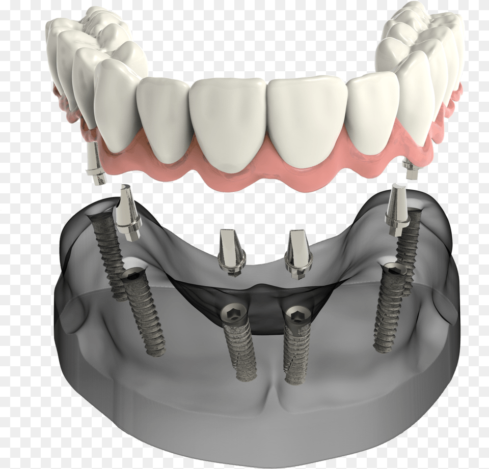 Implant Secured Denture Sudbury Ma Dentist, Body Part, Mouth, Person, Teeth Free Png Download