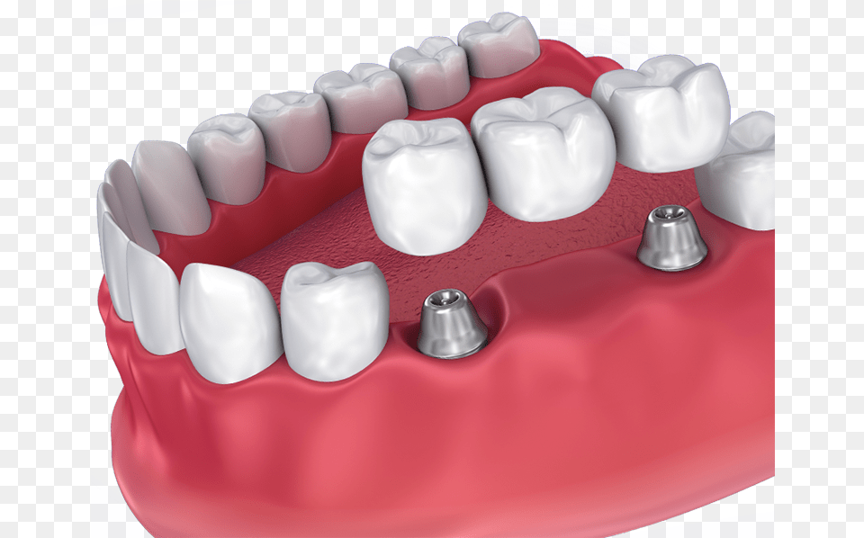 Implant Supported Bridge Dental Crown, Birthday Cake, Person, Mouth, Food Free Png