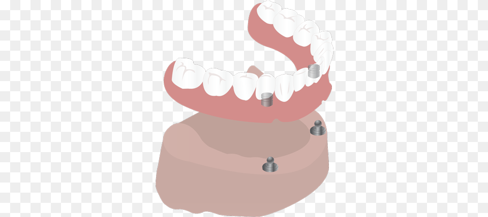 Implant Supported Dentures, Body Part, Mouth, Person, Teeth Free Transparent Png