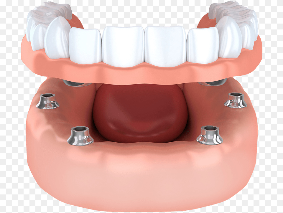 Implant Supported Model Brownstown Mi Snap Dentures, Teeth, Body Part, Person, Mouth Free Transparent Png