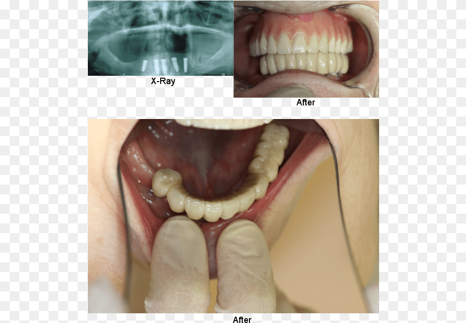 Implants Permanent Teeth Smile Gallery Do Adult Teeth Look Like, Body Part, Mouth, Person, Face Free Png